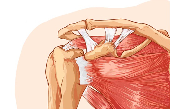 Rotator Cuff Repair